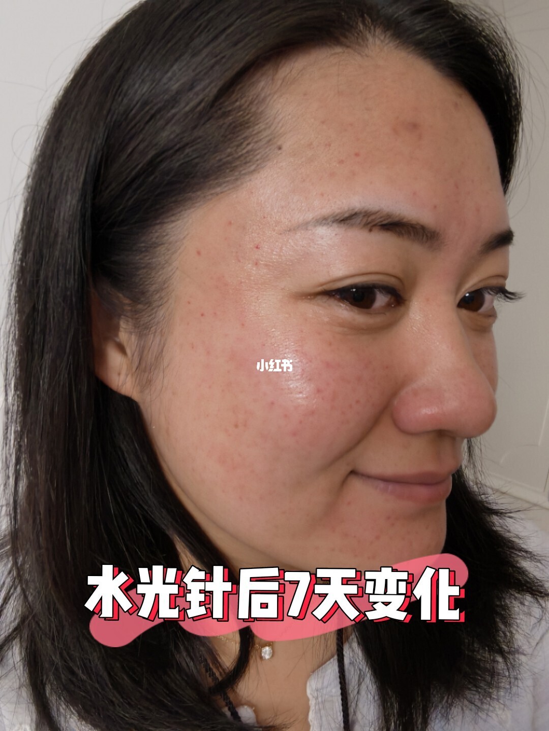 美容店打水光针有副作用吗论坛_男士打美白针副作用吗_打美容针有副作用吗