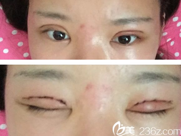开双眼皮需要多少钱啊_双眼开角型青光眼晚期_钱蒙蔽了双眼表情包
