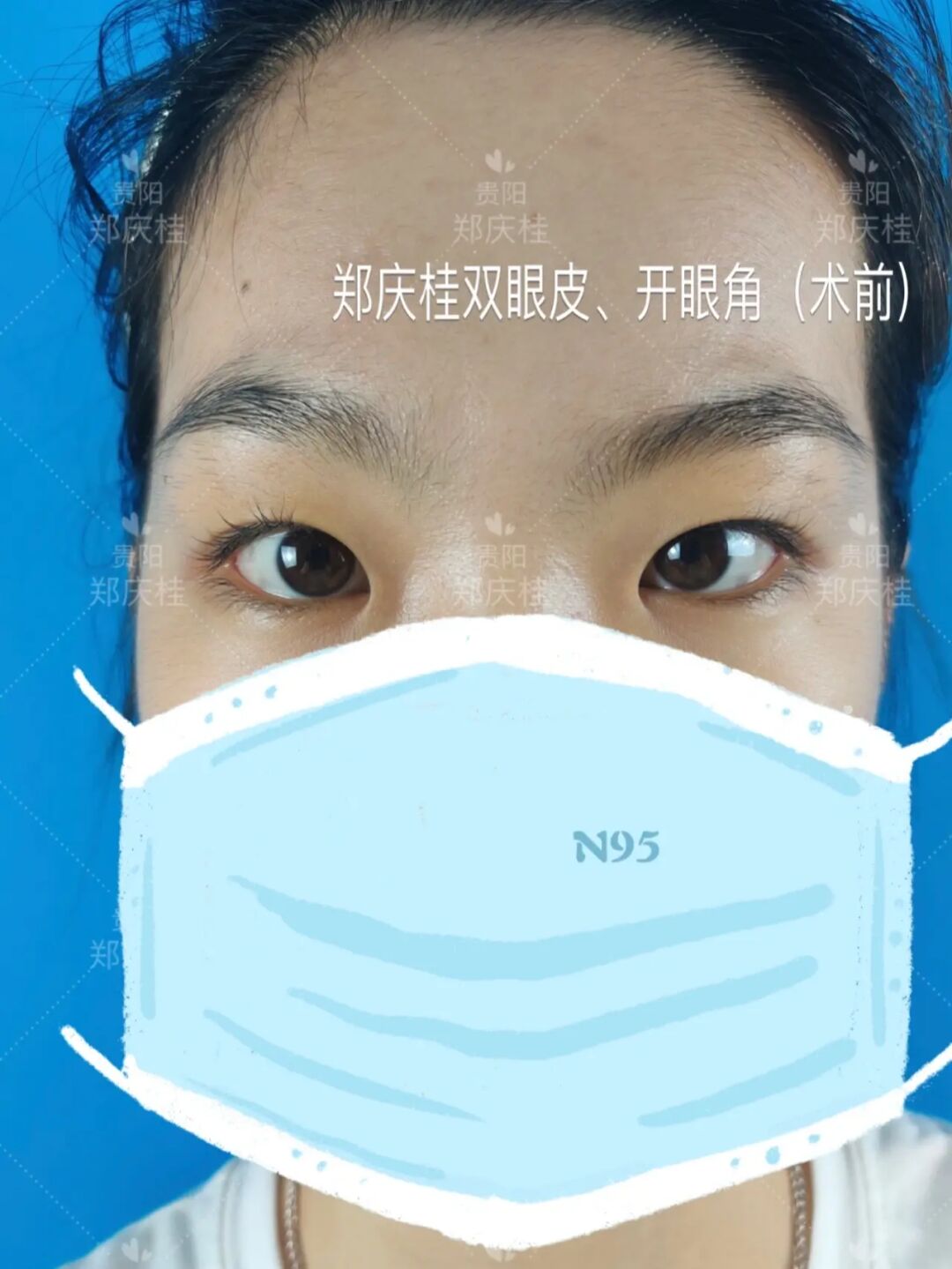 双眼开角型青光眼晚期_钱蒙蔽了双眼表情包_开双眼皮需要多少钱啊