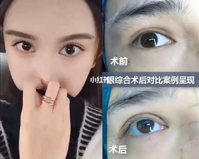 成都哪家医院做双眼皮比较好_做双眼皮的正规医院_做双眼皮的医院妇产科