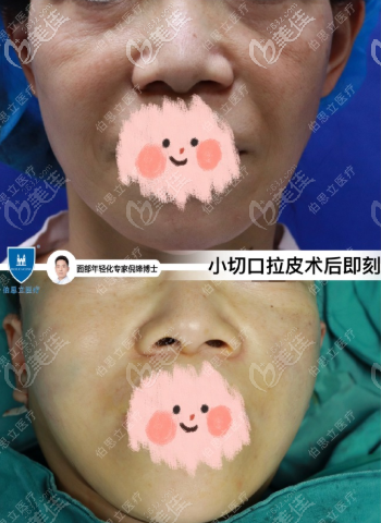 宝尼达真正能维持8年吗_皮秒激光祛斑维持多久_小切口拉皮能维持几年