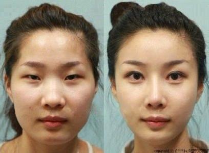 小切口拉皮能维持几年_貉子皮2018年能涨价吗?_心脏支架能维持30年吗