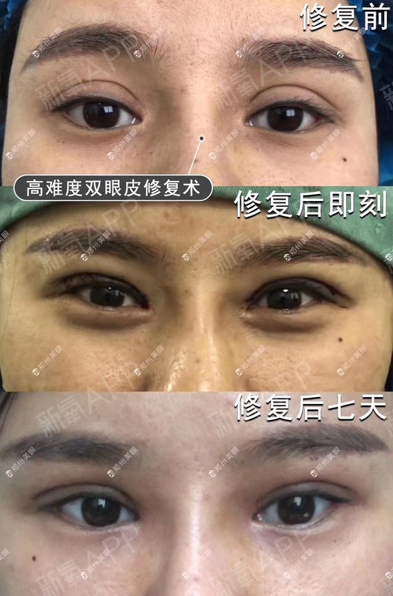 擦色皮好还是压花皮好_郑州羊癫疯专家速问康好_郑州做双眼皮最好专家