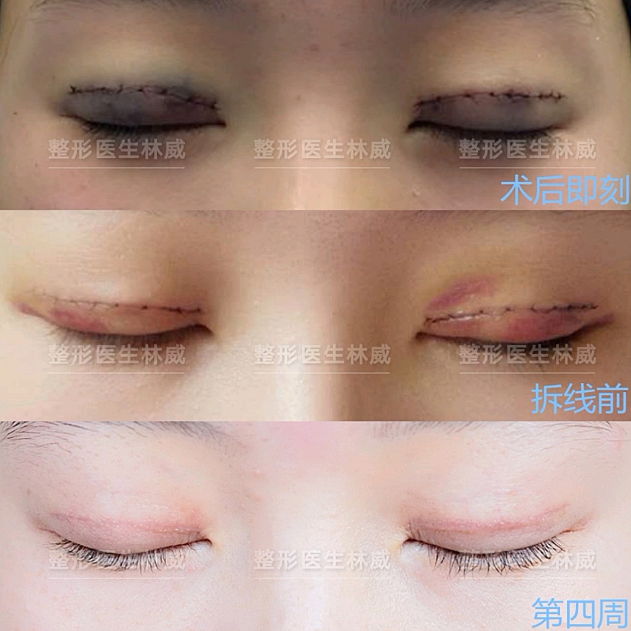 郑州羊癫疯专家詢康好在线_郑州做双眼皮最好专家_郑州哪里做达拉斯隆鼻好
