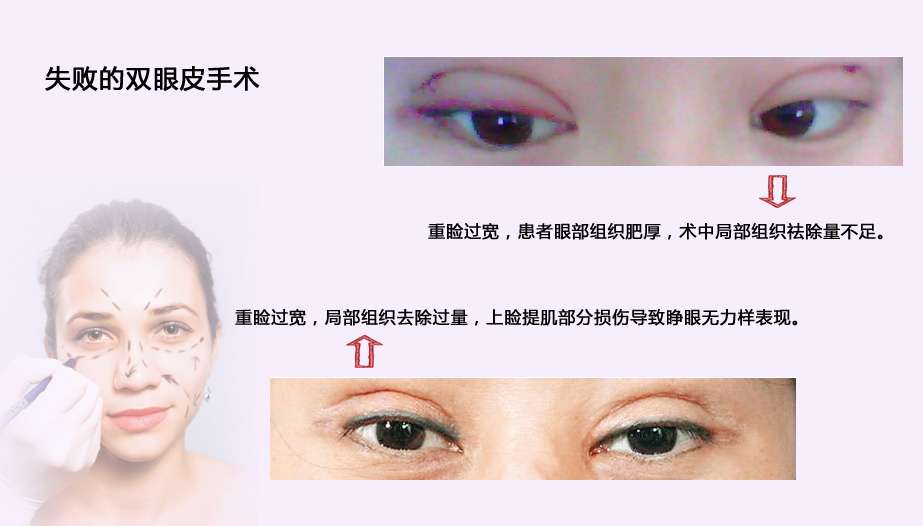 广州双眼皮需要多少钱_双眼皮重新做需要多长时间_双眼皮面诊需要素颜吗