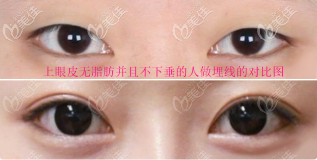 双眼皮重新做需要多长时间_双眼皮面诊需要素颜吗_广州双眼皮需要多少钱