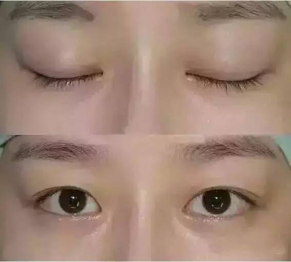 广州双眼皮需要多少钱_双眼皮内眦皮_预钱去看双眼无神