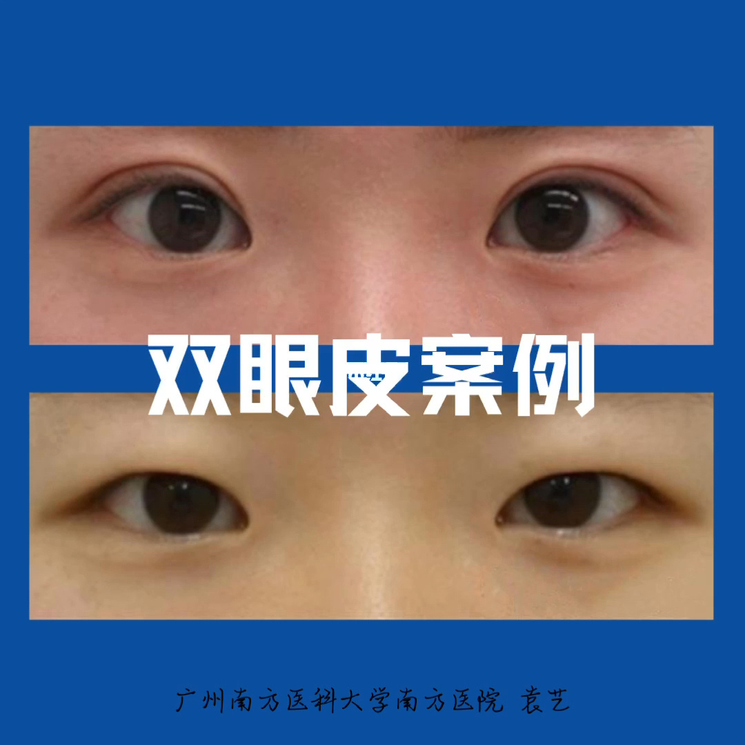 广州双眼皮需要多少钱_预钱去看双眼无神_双眼皮内眦皮