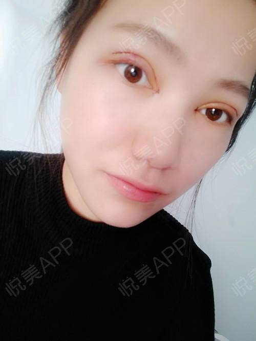 皮手环用什么皮好_徐州哪里双眼皮技术好_徐州哪个医院做无痛人流技术好