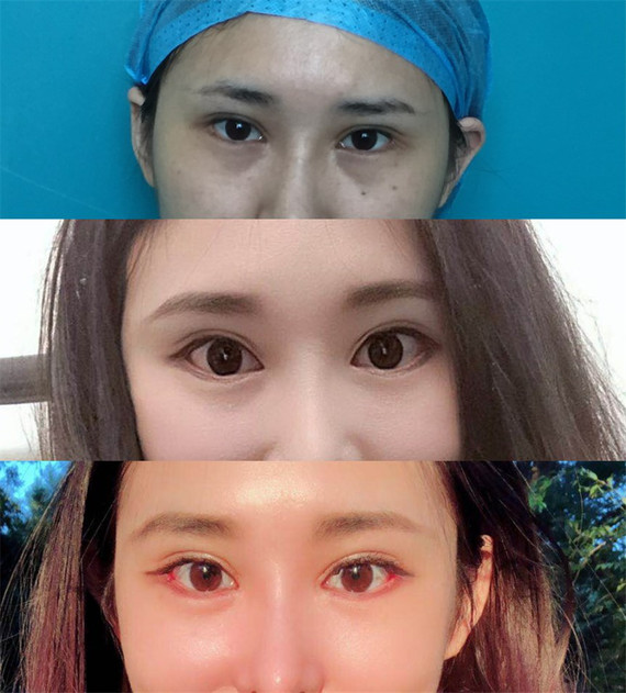 徐州哪里双眼皮技术好_徐州哪个医院做无痛人流技术好_皮手环用什么皮好