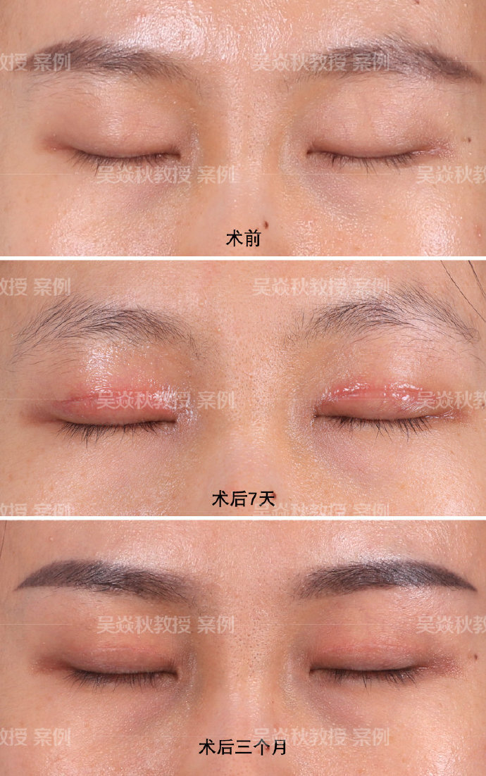上海植发上海美来l便宜_双眼皮修复上海美来l安全_上海整形医院8美来w安全