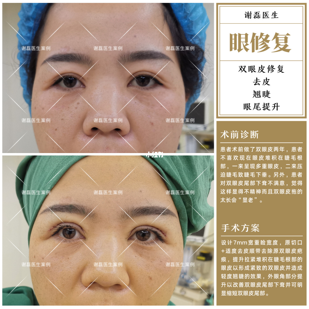 皮阿诺与欧派比较那个整体橱柜好_北京哪里做定点双眼皮比较好_哈市哪家医院做双眼皮开眼角好
