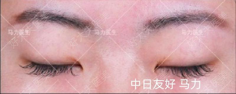 预钱去看双眼无神_什么皮材质做钱包好_一般做个最低的双眼皮多少钱啊