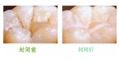 牙齿上有一层东西好臭_17层买7层好还是9层好_吃什么东西对牙齿好