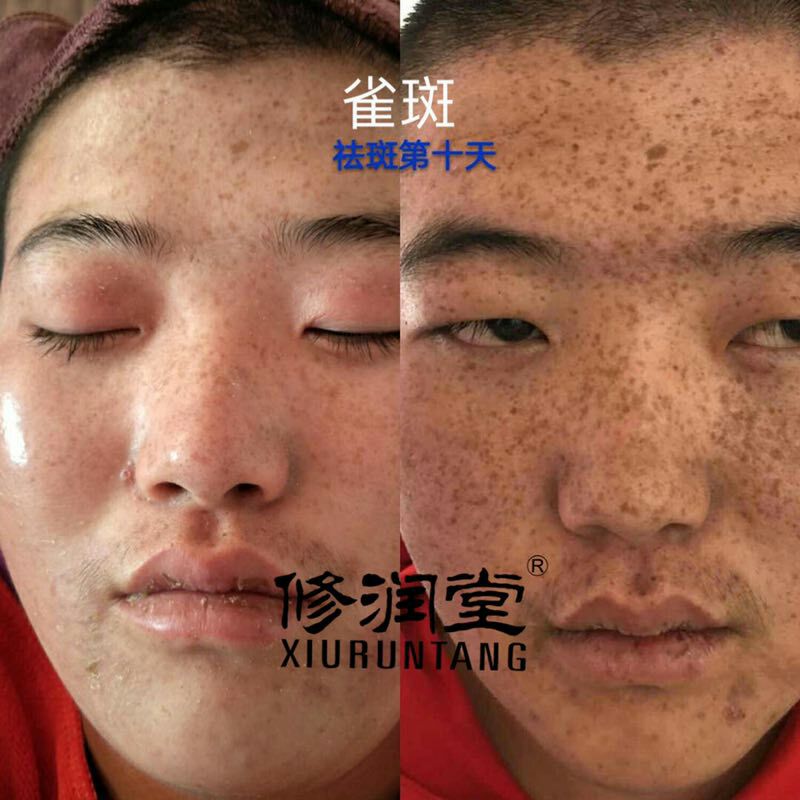 点斑水点斑后注意事项_上环后应注意哪些事项_点斑水点斑安全吗