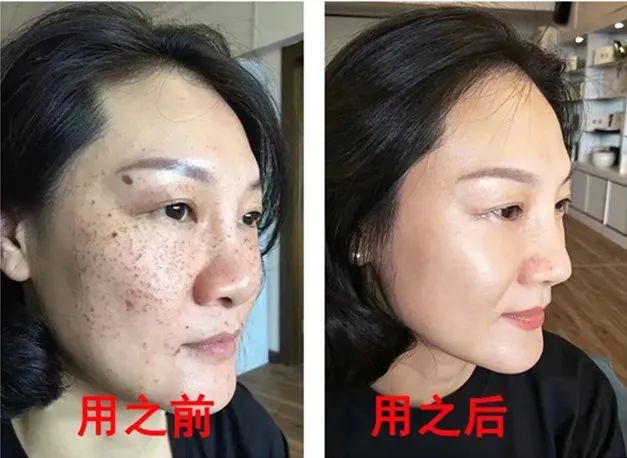 点斑水点斑后注意事项_上环后应注意哪些事项_点斑水点斑安全吗