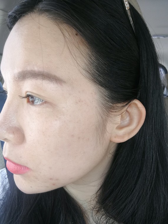 点斑水点斑后注意事项_上环后注意什么事项_点斑水点斑痛吗