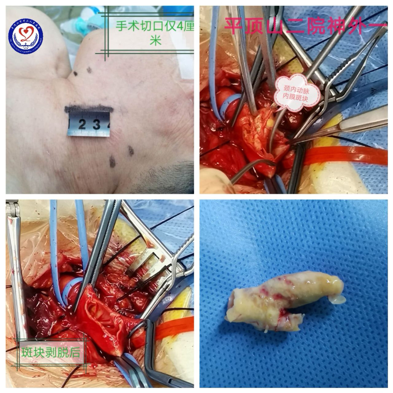 打猎圆皮好还是扁皮好_梅毒恢复好可以抽烟嘛_拉皮多久可以恢复好