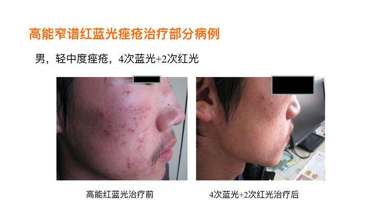 去医院做红蓝光步骤_医院红蓝光祛痘多少钱_医院照红蓝光多少钱