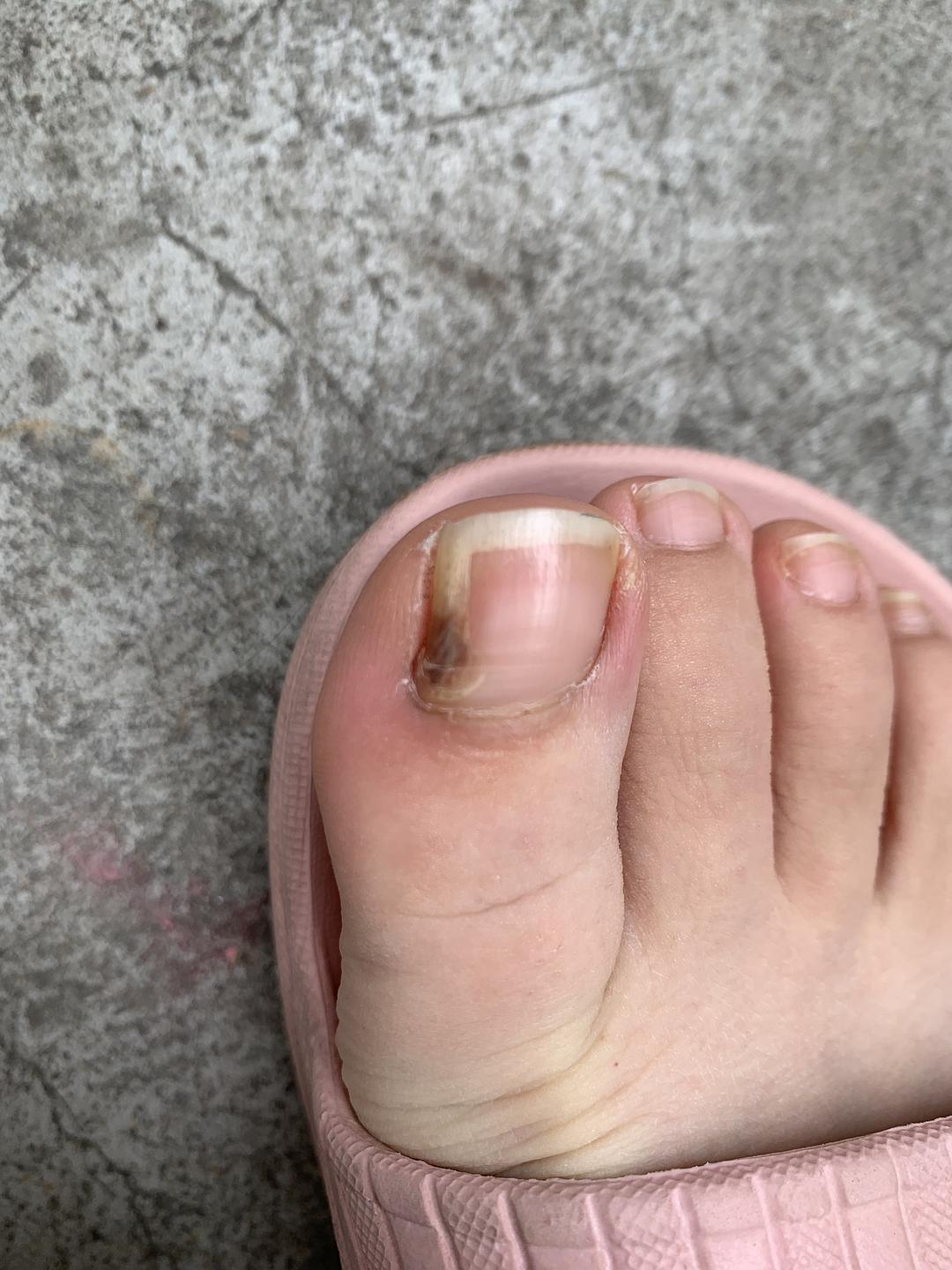 指甲下面长一层软肉_剪指甲剪到肉能长好吗_指甲长到肉里面怎么办
