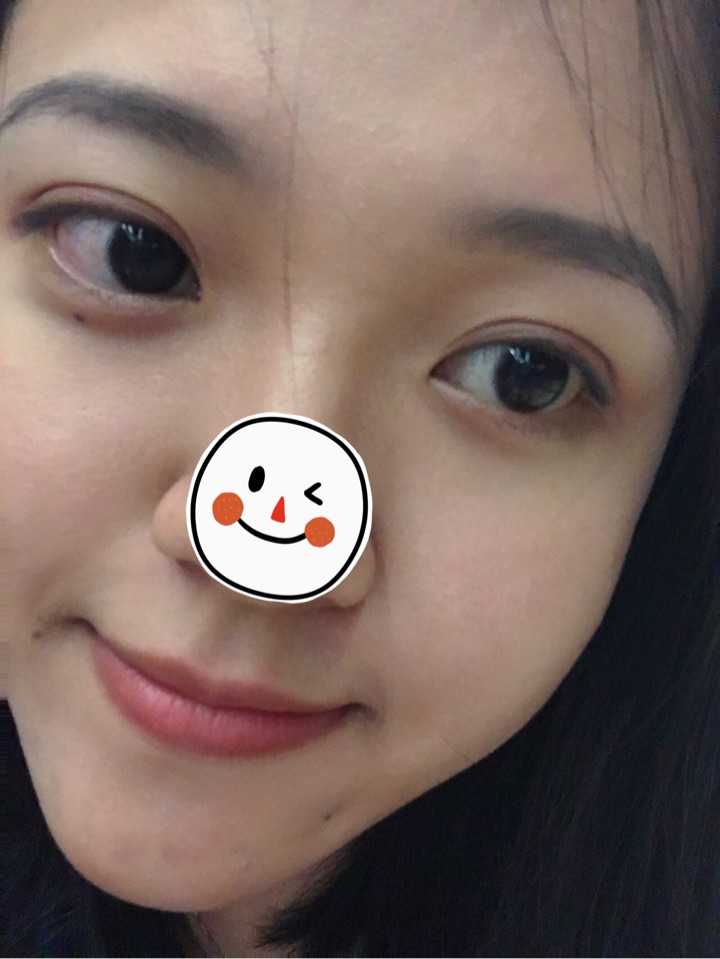 做的切割双眼皮跟内双呢怎么办_切割双眼皮的危害_内双眼妆的画法视频