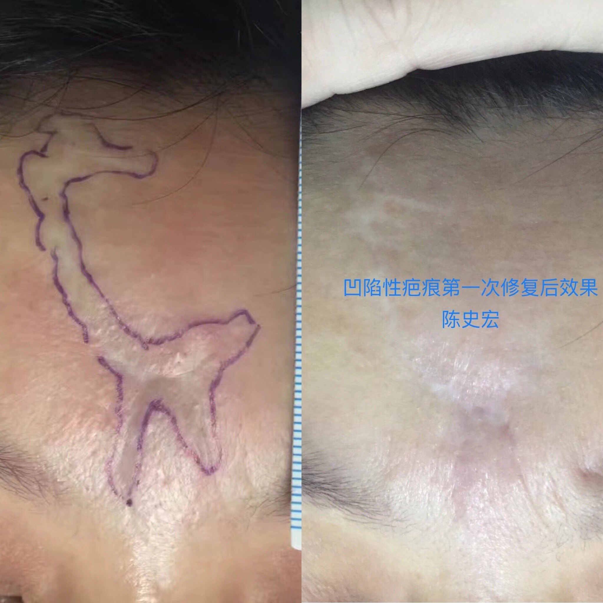 拉皮多久可以恢复好_剖腹产多久可以恢复好_擦色皮好还是压花皮好