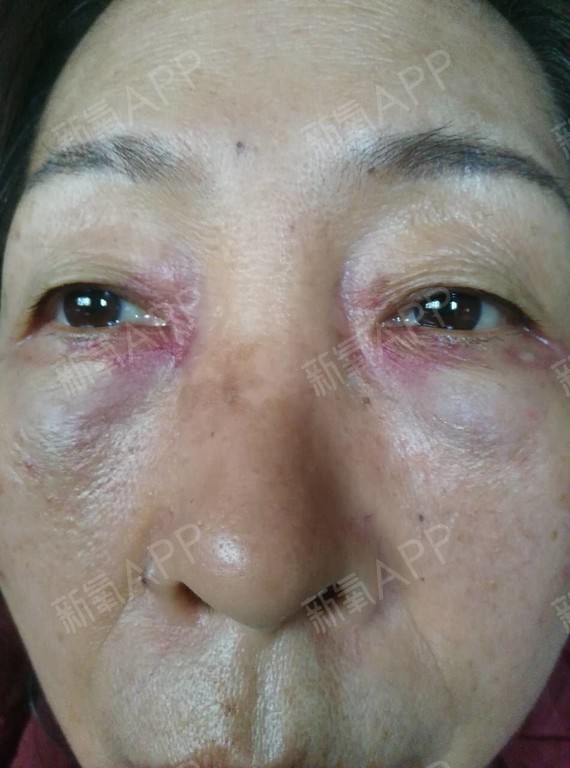 福州激光去色素痣要多少钱_福州去上海动车要多久_福州去永泰高盖山要多久