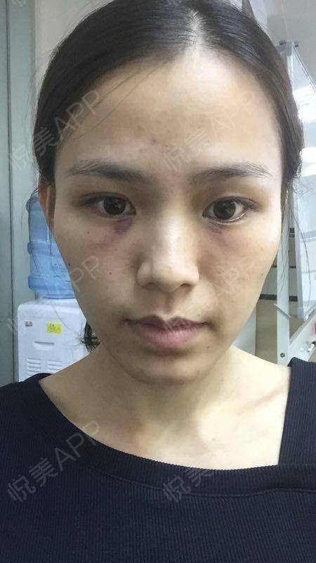 福州激光去色素痣要多少钱_福州去上海动车要多久_福州去永泰高盖山要多久