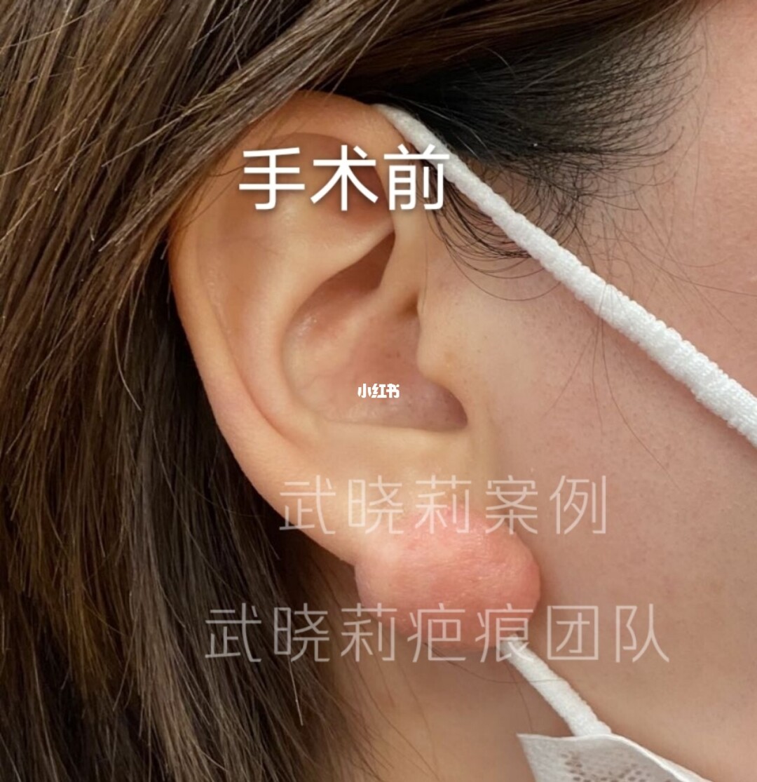 去痣后多久可以恢复好_人流多久可以恢复好_拉皮多久可以恢复好