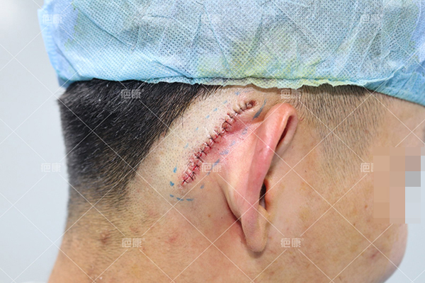 拉皮多久可以恢复好_人流多久可以恢复好_去痣后多久可以恢复好