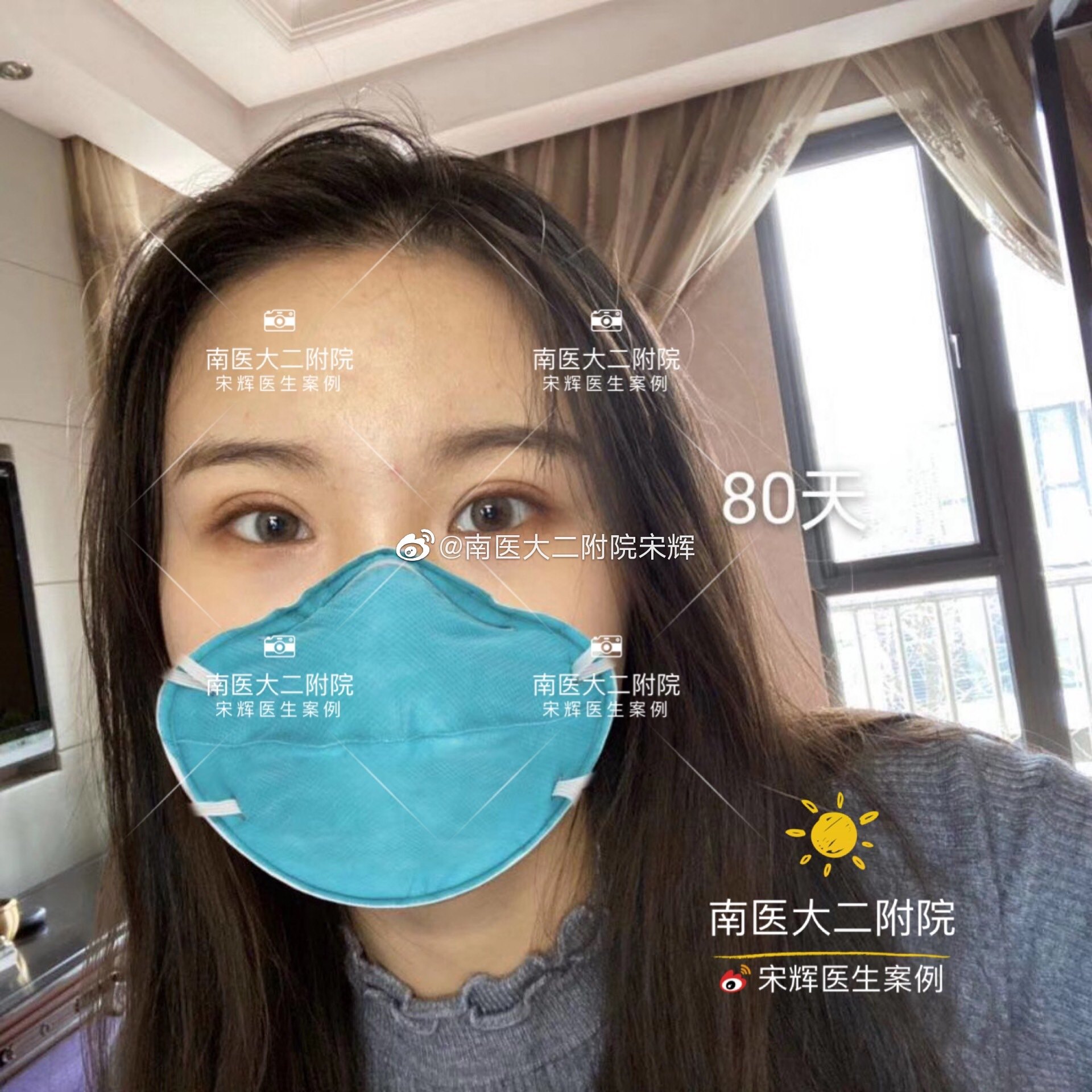 深圳双眼皮开眼角修复_汉中市哪修复双眼皮技术好_哪里有专业修复双眼皮的医院