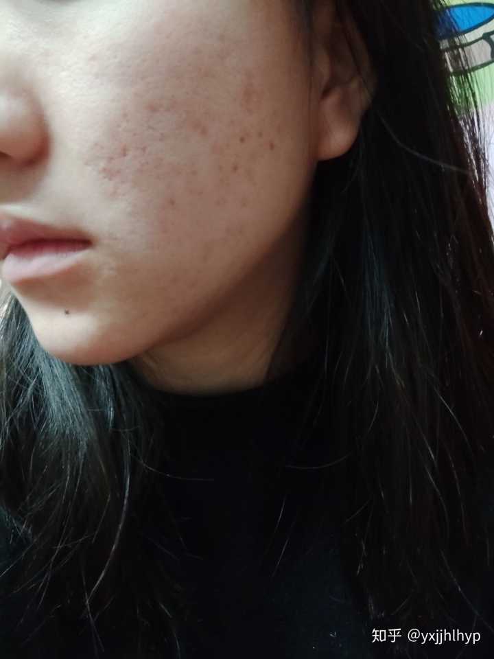 去黑印是维生素几_皮鞋汗渍黑印去不掉怎么办_地板革上的黑印怎么去