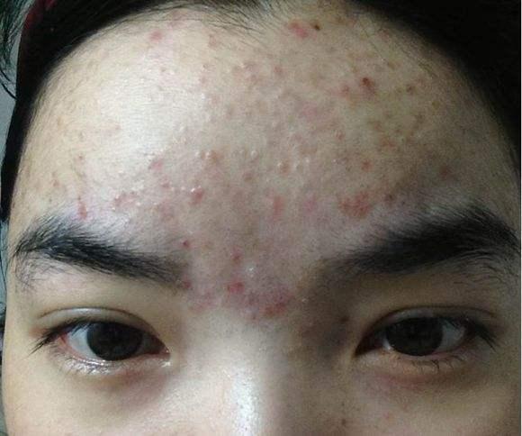 怎么去脸上的黑印_皮鞋黑印去不掉怎么办_去黑印是维生素几