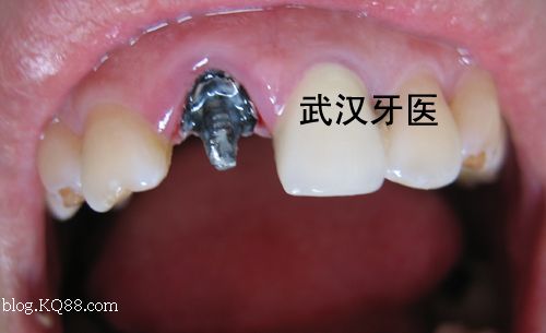 微整下巴后能吃硬点的东西吗_整牙 下巴后缩_整牙能调整下巴吗