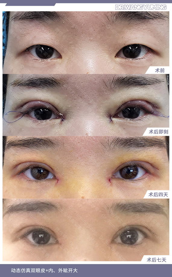 上海开双眼皮哪家医院比较好_上海哪个医院开痔疮好_上海做双眼皮的医院
