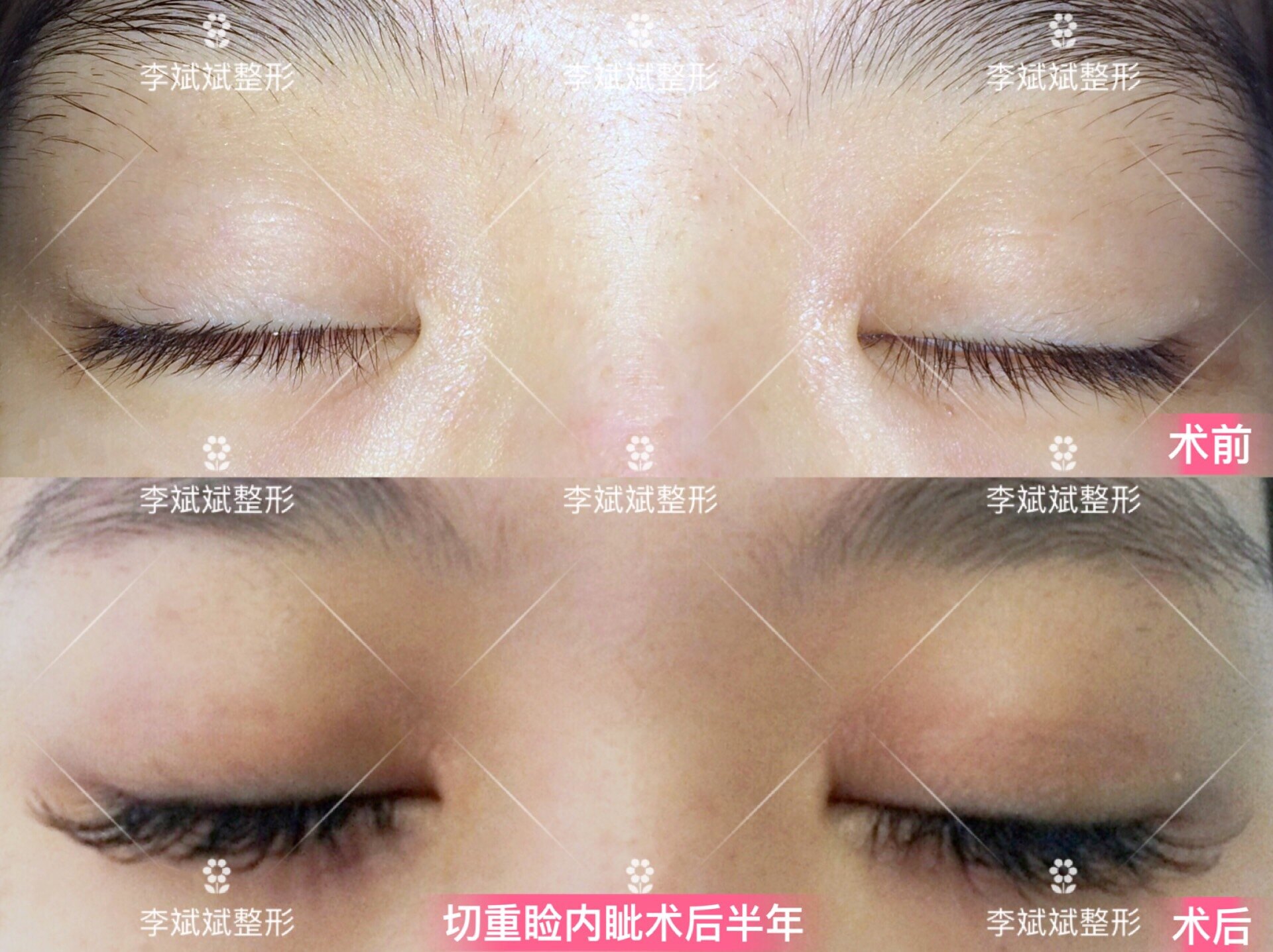 上海哪个医院开痔疮好_上海做双眼皮的医院_上海开双眼皮哪家医院比较好
