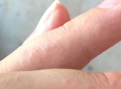 宝宝手指长透明水泡_孩子手指上起透明水泡_手指老是起透明小水泡