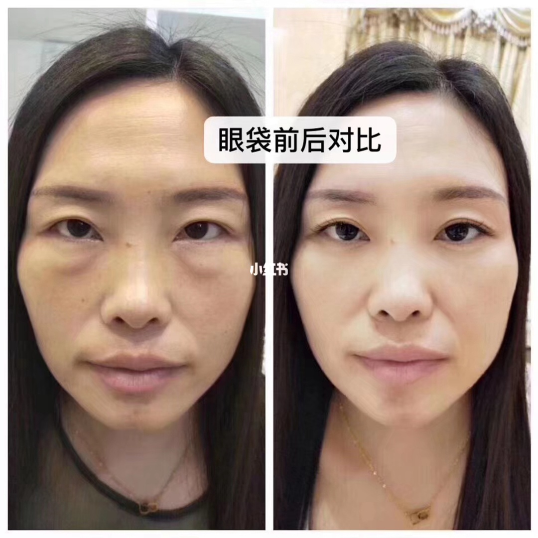 除眼袋要多少钱上海美来l好_上海割双眼皮上海美来l强_做双眼皮上海美来l强