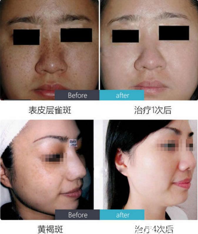 福州激光去色素痣要多少钱_激光去黑色素沉淀 效果_激光去除75㎝长的瘢痕要多上钱