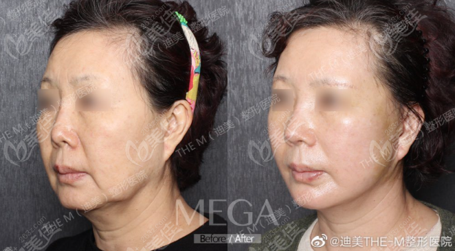 拉皮多久可以恢复好_弹弓扁皮好还是圆皮好_去痣后多久可以恢复好