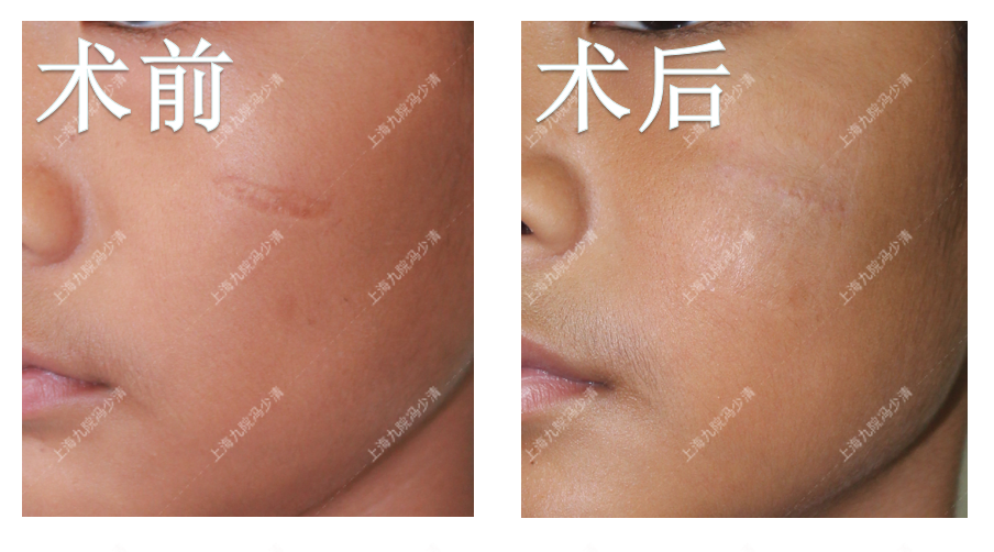 做完眼底吸脂多长时间可以恢复好_拉皮多久可以恢复好_拉皮多久可以恢复好