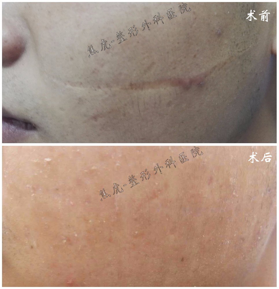 拉皮多久可以恢复好_拉皮多久可以恢复好_做完眼底吸脂多长时间可以恢复好