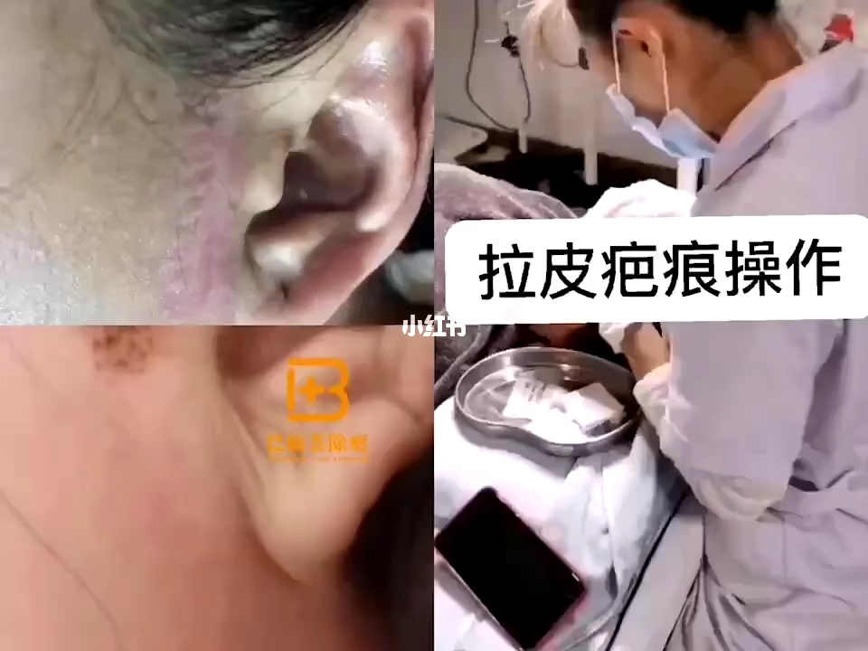 拉皮多久可以恢复好_拉皮多久可以恢复好_做完眼底吸脂多长时间可以恢复好