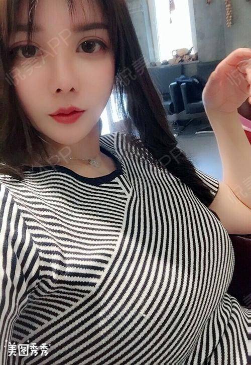 南宁自体脂肪填充术_南宁做隆鼻找东方细心_南宁自体脂肪价格看东方细心