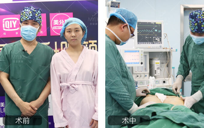 南宁自体脂肪填充术_南宁做隆鼻找东方细心_南宁自体脂肪价格看东方细心