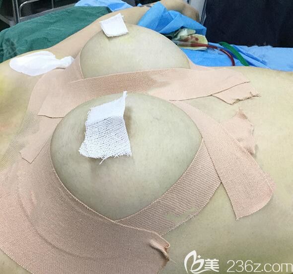 自体脂肪价钱先去南宁东方_南宁自体脂肪价格看东方细心_南宁自体脂肪丰苹果肌