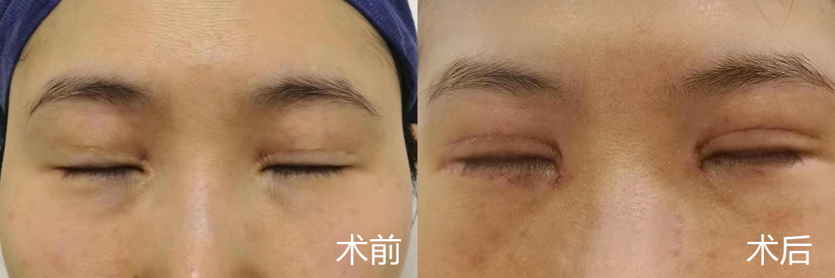 沈阳哪里做双眼皮手术好_沈阳哪家医院做引产手术好_沈阳做双眼皮最好