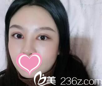 沈阳做双眼皮最好_沈阳做胆囊结石手术哪家医院好_沈阳哪里做双眼皮手术好