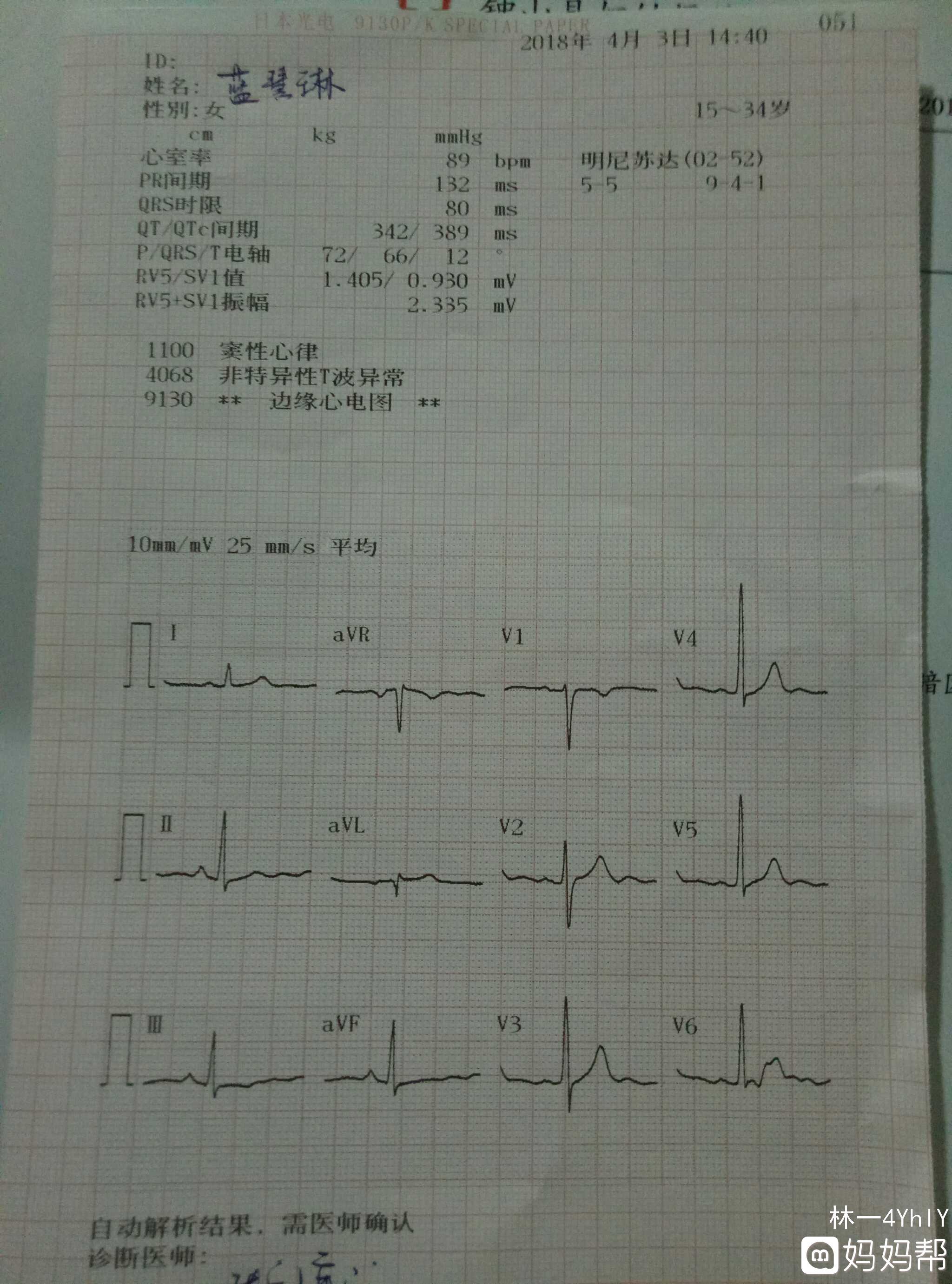 香港验血空腹抽血会有影响吗_做心梗造影前吃饭了有唅影响_空腹做心电图有影响吗