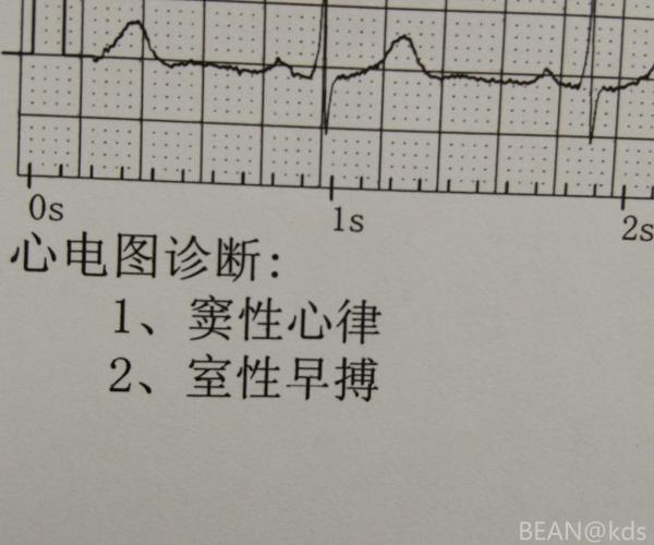 香港验血空腹抽血会有影响吗_空腹做心电图有影响吗_做心梗造影前吃饭了有唅影响